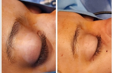Rare 105 gms tumor removed from Teens nasal cavity through scarless endoscopic surgery at Medcare Hospital Sharjah