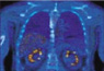 GE Healthcare initiates clinical trials for first-ever PET imaging agent to track angiogenesis in cancer