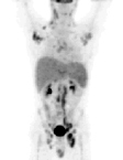 PET Imaging in extensive Lymphoma